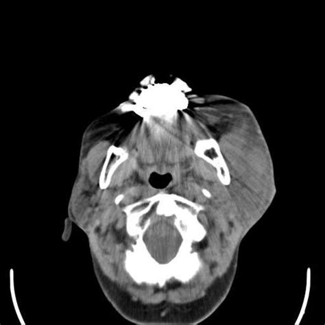 Parotitis Ct Or Mri Wikidoc