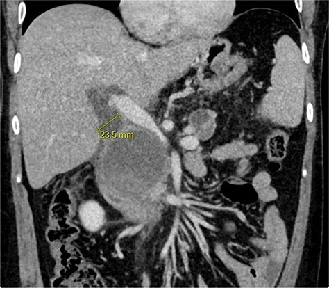 Diagnosis And Treatment Of A Biliary Fistula To Walled Off Pancreatic Necrosis Videogie