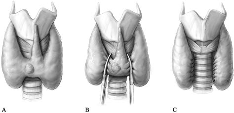 Thyroid Isthmusectomy A Rarely Used But Simple Safe And Efficacious