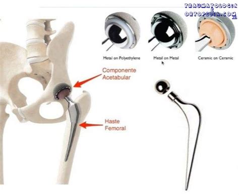Componentes Da Pr Tese Total De Quadril Traumatologia E Ortopedia