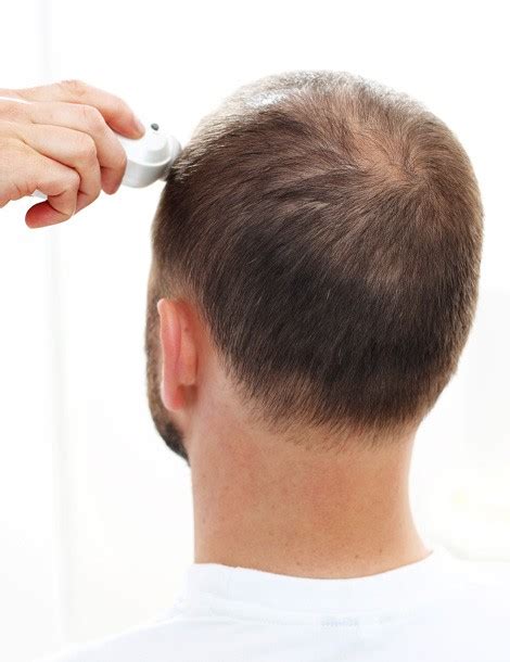 Solutions calvitie et perte de cheveux homme Rosemère Rive Nord