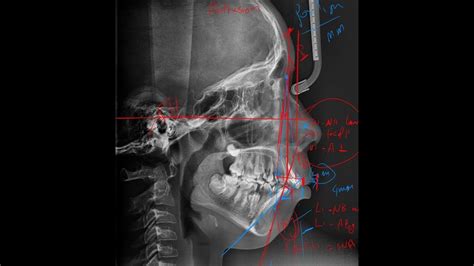 14 Proclination Vs Protrusion In Cephalometric Analysis Cephalometric Analysis Youtube