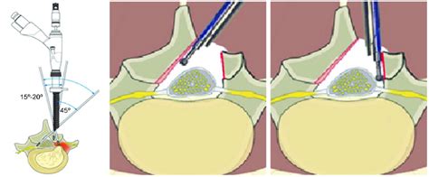 Unilateral Approach And Bilateral Decompression The Bilateral