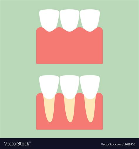 Healthy Incisor Tooth On Gum For Dental Care Vector Image