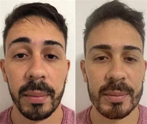 Veja O Antes E Depois De Famosos Que Fizeram Harmoniza O Facial