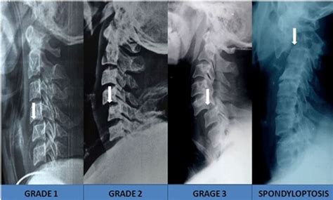 Figure Meyerding Grades Of Spinal Subluxation Statpearls Ncbi