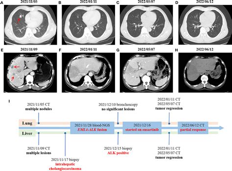 Frontiers An Unresectable And Metastatic Intrahepatic