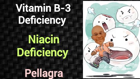 Vitamin B3 Deficiency Niacin Deficiency Pellagra Psm Lecture