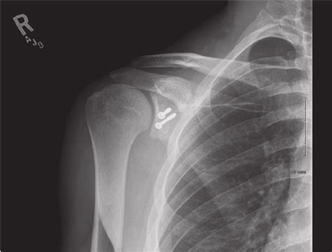 An Anterior Posterior View Of The Right Shoulder Following The Latarjet