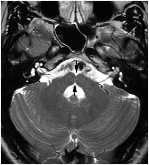 Horizontal Gaze Palsy With Progressive Scoliosis Secondary To Robo