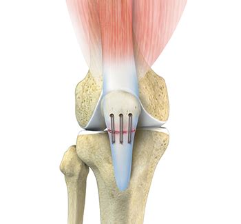 Patellar Tendon Rupture Repair