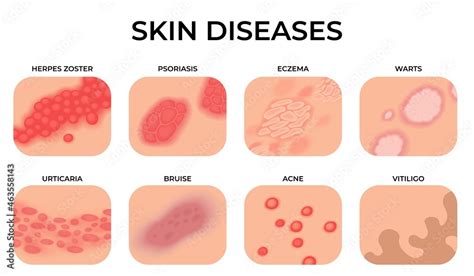 Skin disease. Different diseases, epidermis surface with eczema. Dermatology, allergy symptoms ...