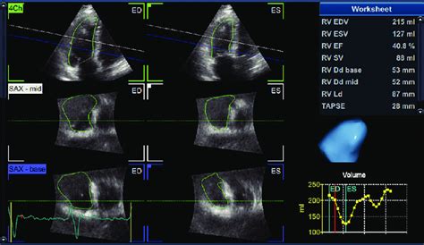 Right ventricular volumes on three-dimensional echocardiography in a ...