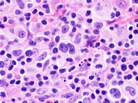 Lymphoma Slide