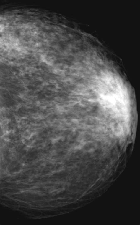 Histologically Proven Normal Breast Parenchyma In A 69 Year Old Woman