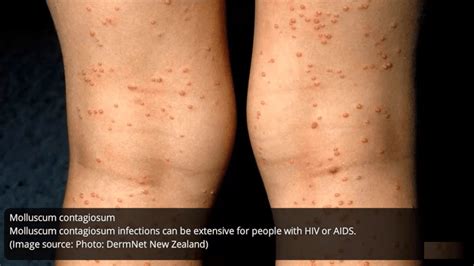 What Does Hiv Rash Looks Like Std Testing Near Me