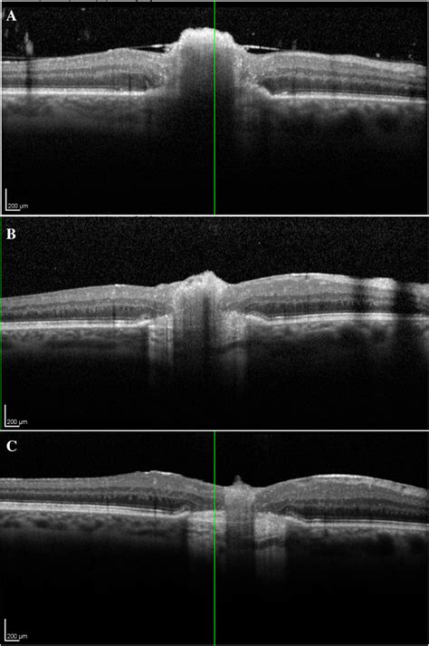 Regression Of The Chorioretinal Lesion Sd Oct Imaging Performed 1 Week