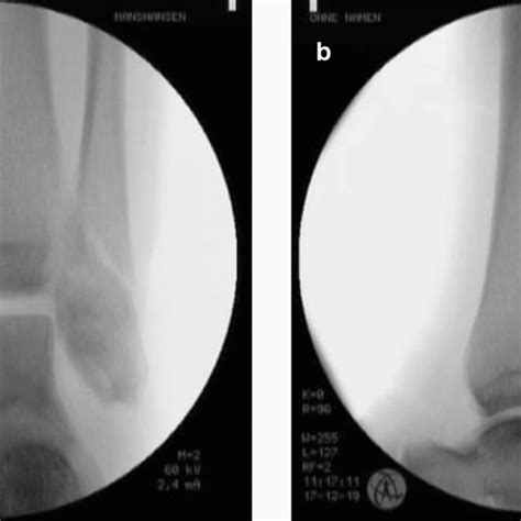 Radiograph Of An Unrealistic Pilon Fracture With A Split Fracture