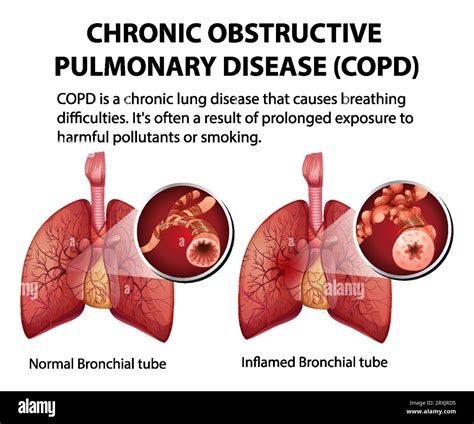 Eine Illustrierte Infografik Zur Erkl Rung Der Chronisch Obstruktiven