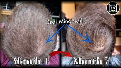 Minoxidil Results