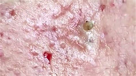 Blackhead Acne Removal For 2024 Whiteheads Milia Comedones Youtube