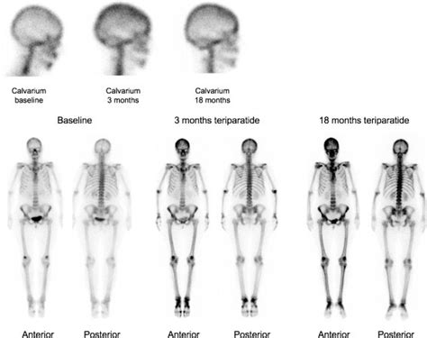 99mtc Mdp Anterior And Posterior Whole Body Bone Scans And Right