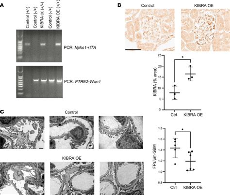 Podocyte Specific Overexpression Of Kibra Increases Susceptibility To