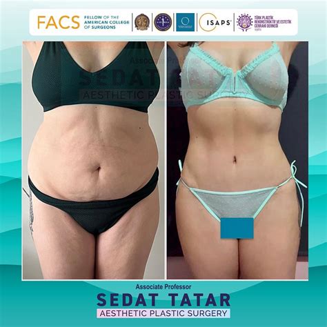 Tummy Tuck Sedat Tatar MD FACS Plastic Surgeon In Turkey