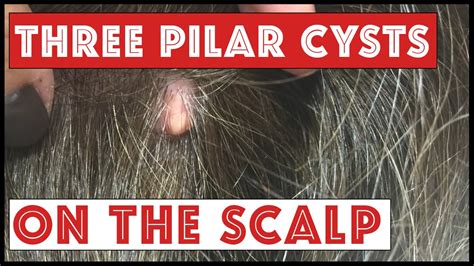 Epidermoid Cyst Scalp