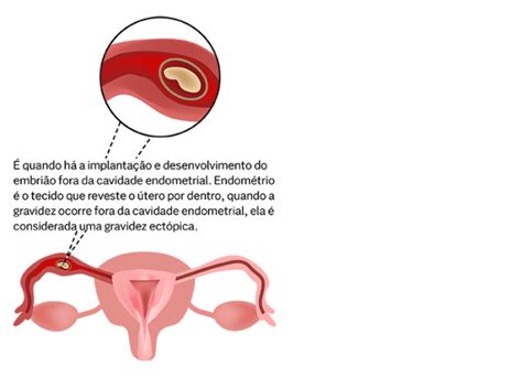 Gravidez Ect Pica O Que Sintomas Causas E Tratamento Nav