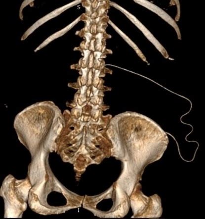 Lumboperitoneal Shunt Image Radiopaedia Org