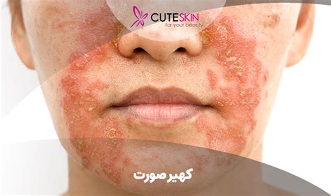 کهیر صورت؛ علائم، دلایل و روش درمان سریع خانگی کیوت مگ Cuteskin