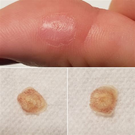 HELP! This nasty fell off after cryo. Am I free or is that still wart