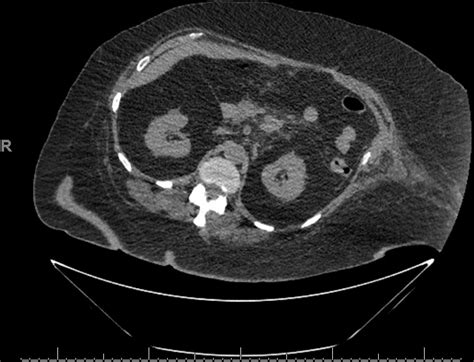 Spontaneous Duodenal Fistulisation From Walled Off Pancreatic Necrosis Bmj Case Reports