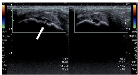 Sinding Larsen Johansson Syndrome Sports Medicine Review