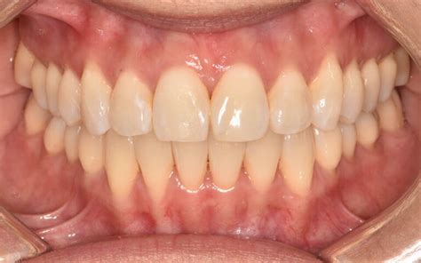 About Blackburn Orthodontics Braces Invisalign In Melbourne