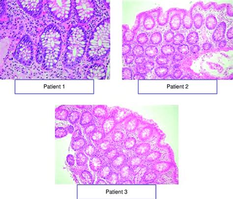 Histopathological Findings In Colon Specimens Obtained During Download Scientific Diagram