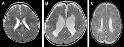 Periventricular Leukomalacia MRI