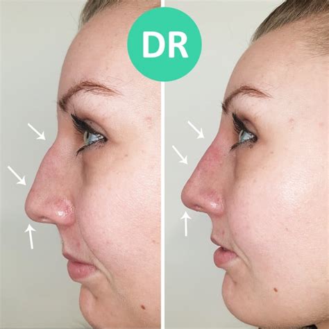 Bump On Nose Treatment Without Surgery Dr Aesthetica