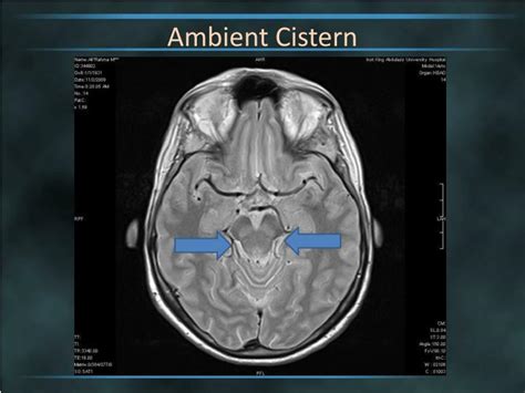 Ppt Brain Cisterns Powerpoint Presentation Id2263744