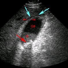 Diagnosis for Acute Cholecystitis: Major Criteria Gallstones ...