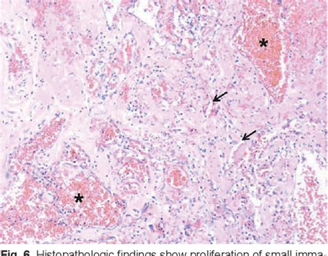 Figure From A Case Of Mixed Hemangioma Of Maxillary Sinus Semantic