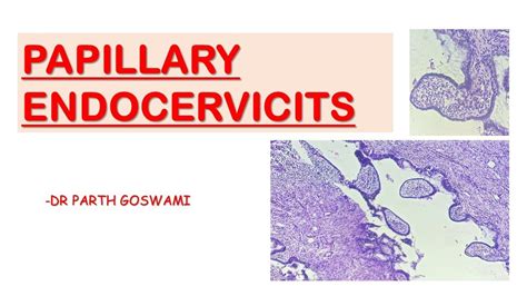 Papillary Endocervicitis Youtube