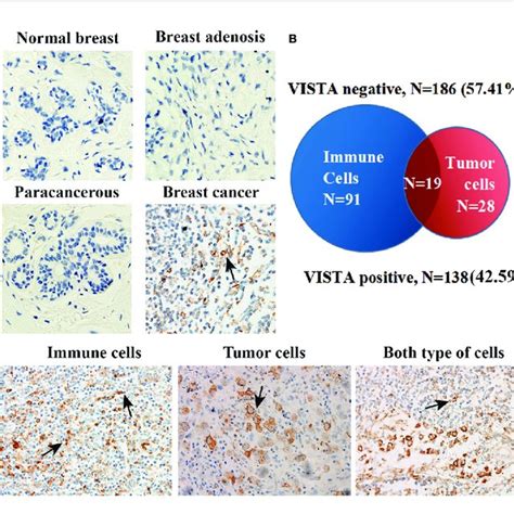 Vista Expression Pattern In Human Breast Cancer Tissue A