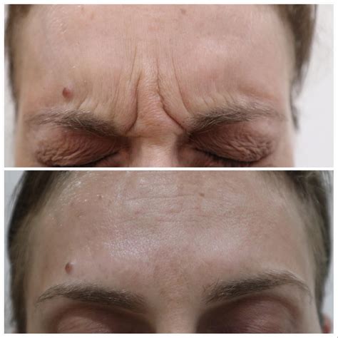 Anti Wrinkle Injections Sydney Cosmetic Injectables La Sante