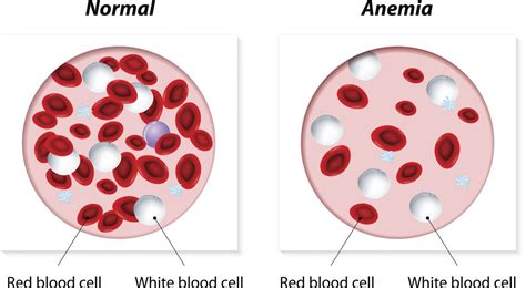 Anemia Guide: Causes, Symptoms and Treatment Options