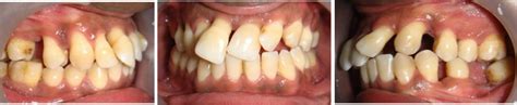 Periodontal Health And Orthodontics Intechopen