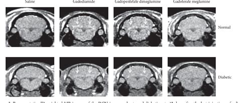 Figure 3 From Gadolinium Retention And Clearance In The Diabetic Brain