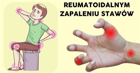 Wszystko co trzeba wiedzieć o reumatoidalnym zapaleniu stawów