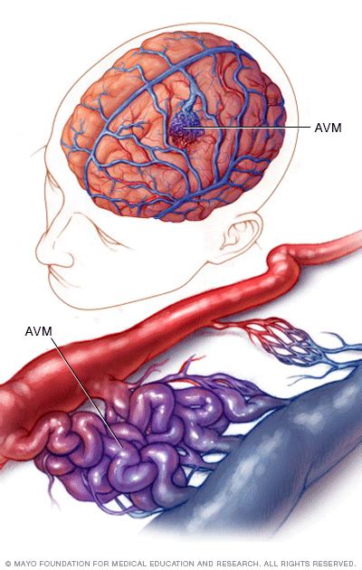 Brain Avm Arteriovenous Malformation Disease Reference Guide Drugs